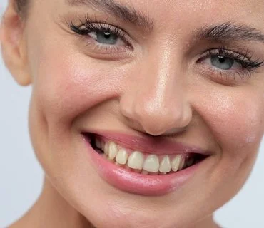 What Is Cheek Dimple Surgery?